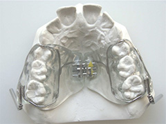 solucion de ortodoncia pul 1