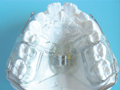 solucion de ortodoncia pul 5