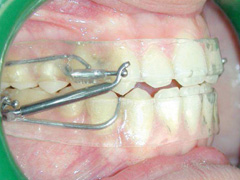 Dispositivo ortodoncia removible pul 18